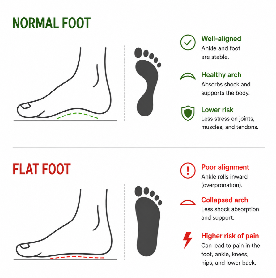 A normal foot with a raised arch compared with a flat foot: the flat foot's arch has collapsed onto the ground, the ankle rolls inward, and there is less shock absorption